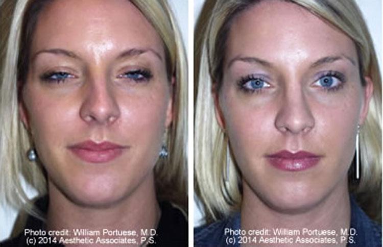The Portland Center For Facial Plastic Surgery rhinoplasty result — Portland, OR