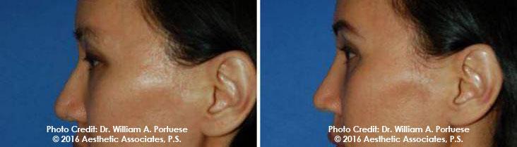 The Portland Center For Facial Plastic Surgery eyelid lift result — Portland, OR