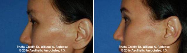 Blepharoplasty before at The Portland Center For Facial Plastic Surgery in Portland, OR