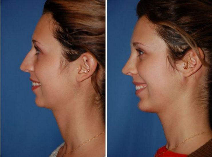 The Portland Center For Facial Plastic Surgery rhinoplasty result — Portland, OR