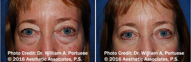 Blepharoplasty result at The Portland Center For Facial Plastic Surgery in Portland, OR