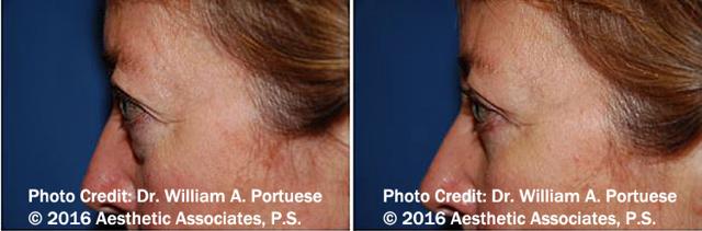 Blepharoplasty result at The Portland Center For Facial Plastic Surgery in Portland, OR