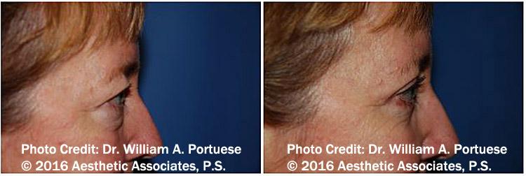 The Portland Center For Facial Plastic Surgery eyelid lift result — Portland, OR