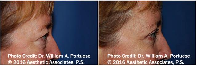 Blepharoplasty result at The Portland Center For Facial Plastic Surgery in Portland, OR