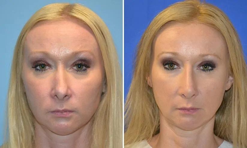 Formation (Gopal Grandhige, MD) rhinoplasty result — Tampa, FL