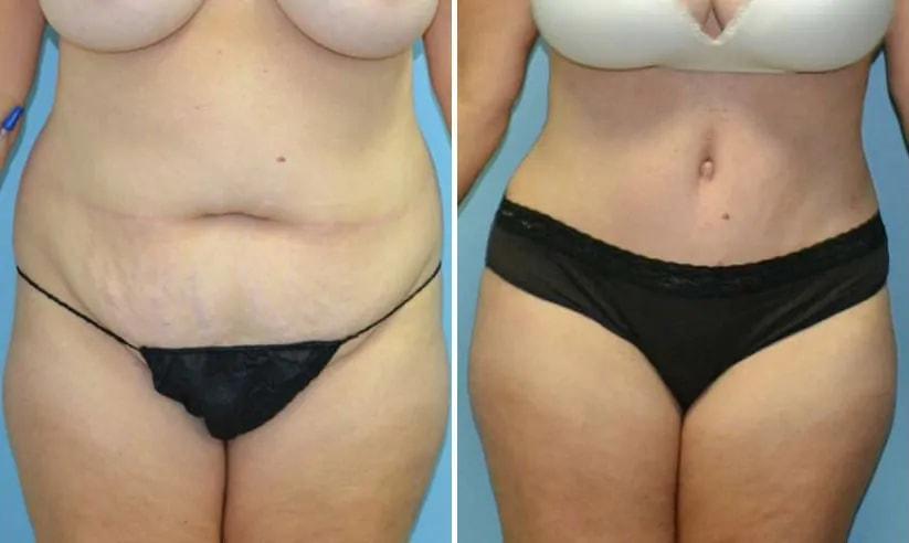 Formation (Gopal Grandhige, MD) tummy tuck result — Tampa, FL