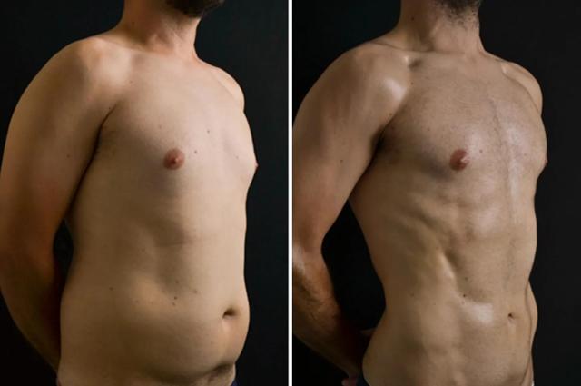 Liposuction result at Formation (Gopal Grandhige, MD) in Tampa, FL