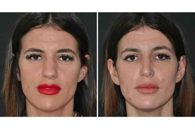 Rhinoplasty result at Formation (Gopal Grandhige, MD) in Tampa, FL