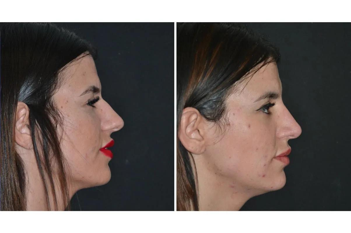 Formation (Gopal Grandhige, MD) rhinoplasty result — Tampa, FL