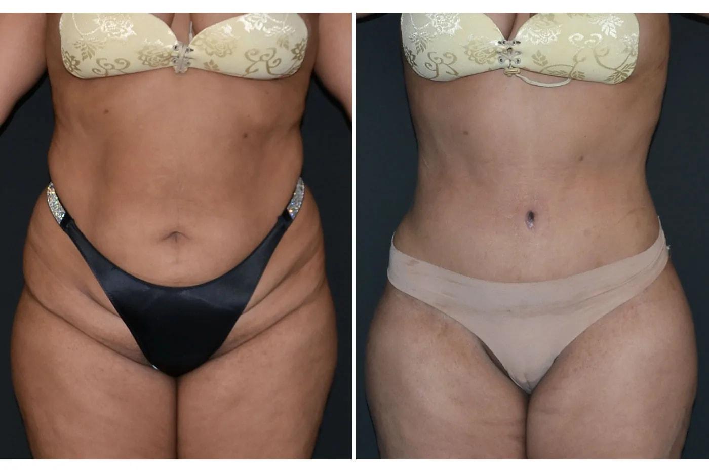 Formation (Gopal Grandhige, MD) tummy tuck result — Tampa, FL