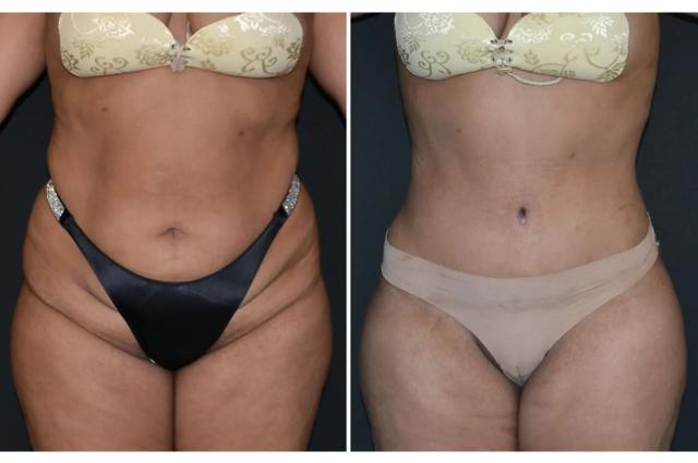 Mini Tummy Tuck result at Formation (Gopal Grandhige, MD) in Tampa, FL