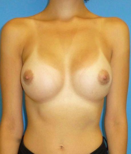 Florence Mussat, MD breast augmentation after — Chicago, IL