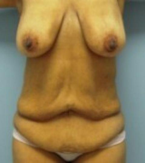 Mommy Makeover before at Florence Mussat, MD in Chicago, IL