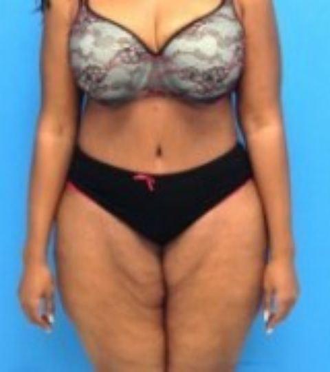 Tummy Tuck after at Florence Mussat, MD in Chicago, IL