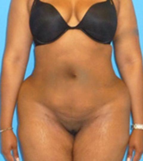 Florence Mussat, MD liposuction after — Chicago, IL