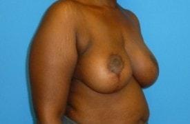 Florence Mussat, MD breast lift after — Chicago, IL