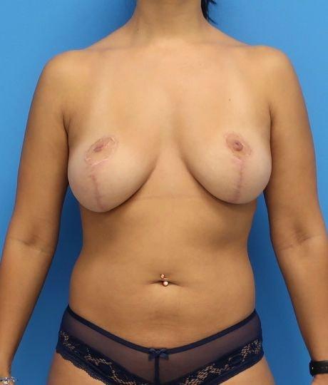 Florence Mussat, MD breast lift after — Chicago, IL
