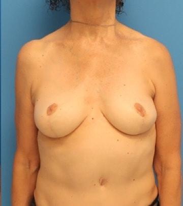 Florence Mussat, MD breast implant removal after — Chicago, IL