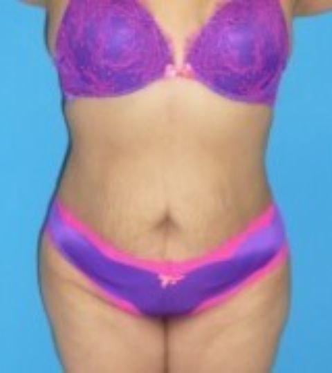 Florence Mussat, MD liposuction after — Chicago, IL