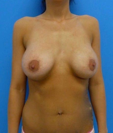 Florence Mussat, MD breast augmentation after — Chicago, IL