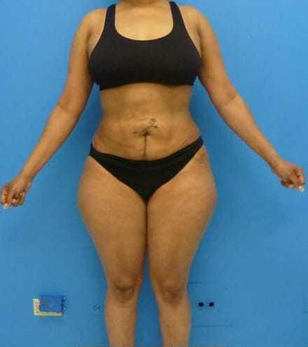 Florence Mussat, MD liposuction after — Chicago, IL