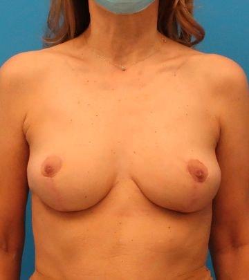 Florence Mussat, MD breast implant removal after — Chicago, IL