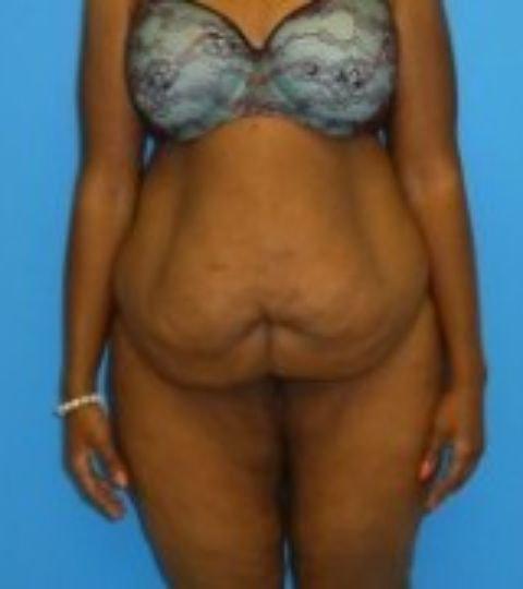 Tummy Tuck before at Florence Mussat, MD in Chicago, IL