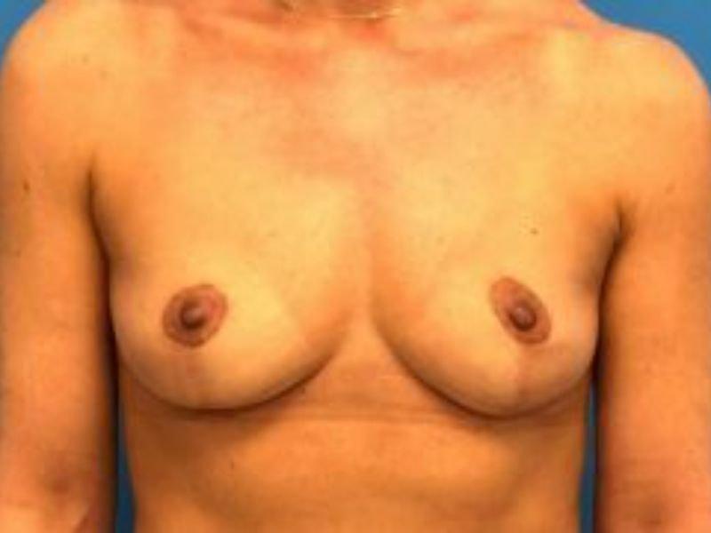 Florence Mussat, MD breast implant removal after — Chicago, IL