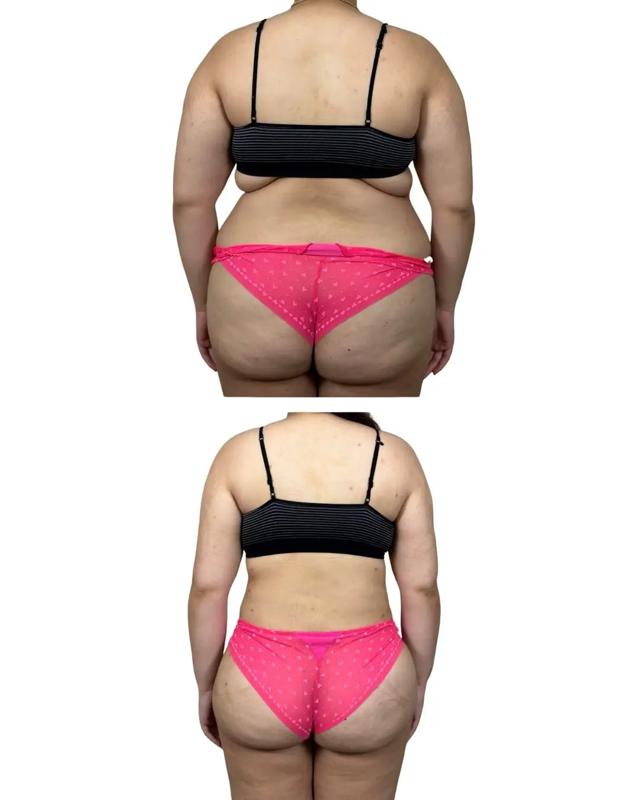 Brazilian Butt Lift result at VG Signature (Vipul Gargya, MD) in Tampa, FL