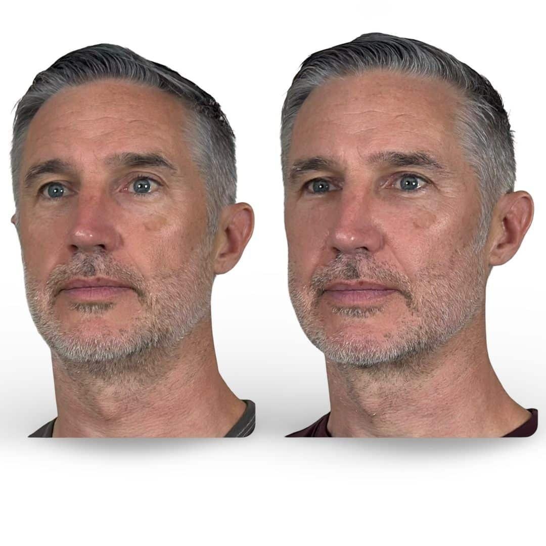 VG Signature (Vipul Gargya, MD) fat transfer result — Tampa, FL