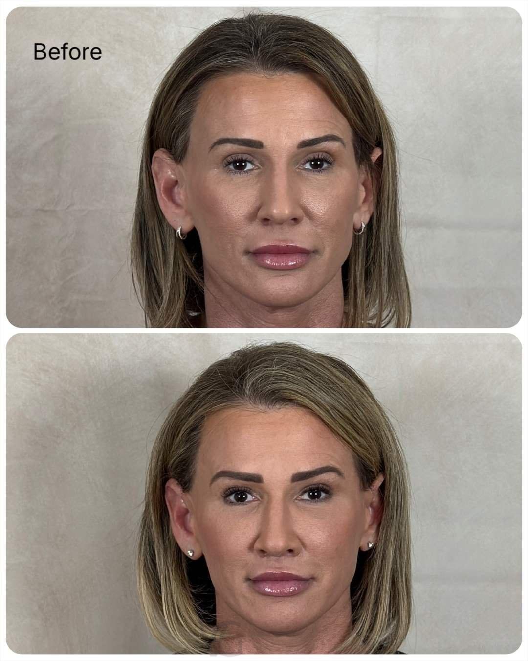 VG Signature (Vipul Gargya, MD) lip lift result — Tampa, FL