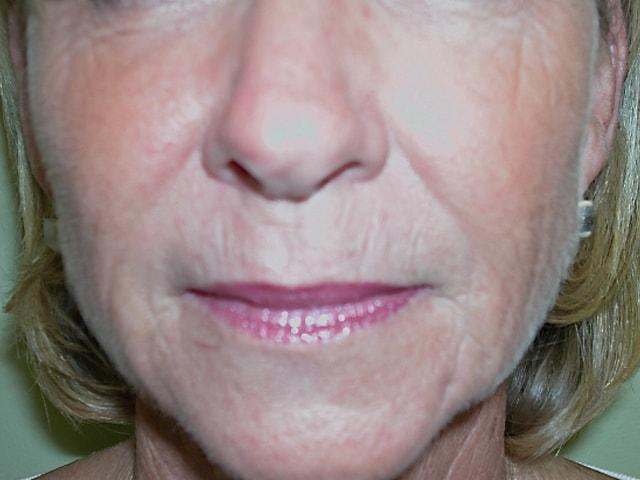 Adler Facial Plastic Surgery (Stephen C. Adler, MD) fat transfer after — Coral Gables, FL
