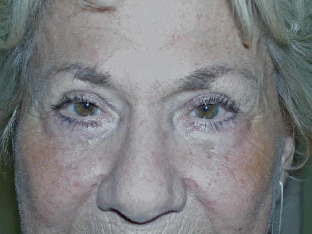 Adler Facial Plastic Surgery (Stephen C. Adler, MD) eyelid lift after — Coral Gables, FL