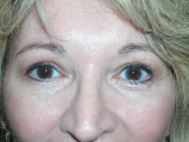 Adler Facial Plastic Surgery (Stephen C. Adler, MD) eyelid lift after — Coral Gables, FL