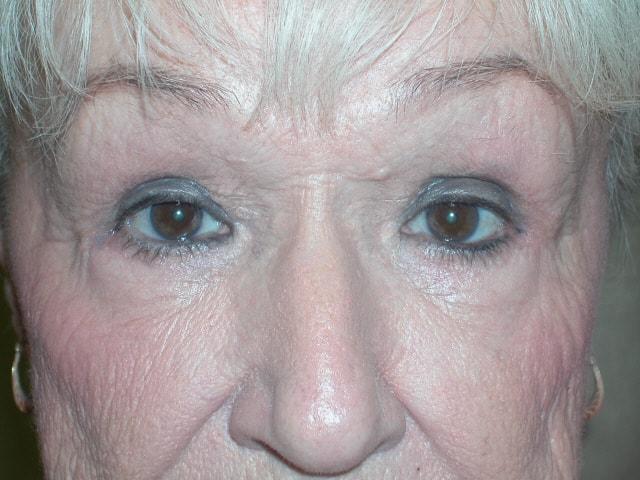 Adler Facial Plastic Surgery (Stephen C. Adler, MD) eyelid lift after — Coral Gables, FL