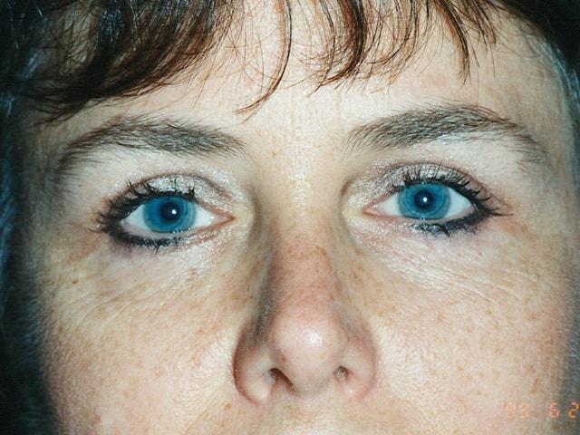 Adler Facial Plastic Surgery (Stephen C. Adler, MD) eyelid lift after — Coral Gables, FL
