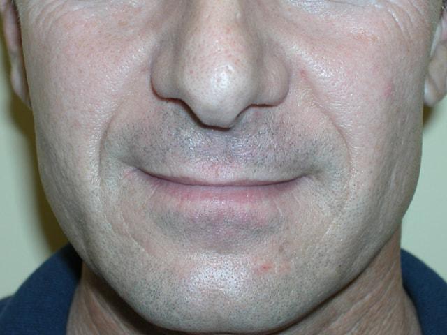 Adler Facial Plastic Surgery (Stephen C. Adler, MD) fat transfer after — Coral Gables, FL