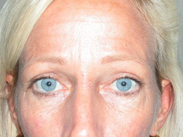 Adler Facial Plastic Surgery (Stephen C. Adler, MD) eyelid lift after — Coral Gables, FL