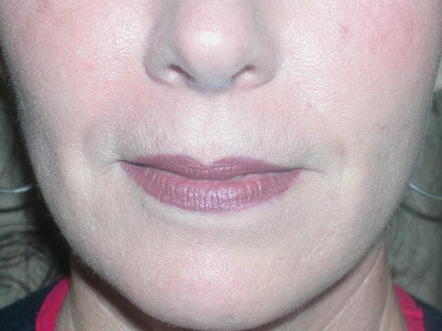 Adler Facial Plastic Surgery (Stephen C. Adler, MD) fat transfer after — Coral Gables, FL
