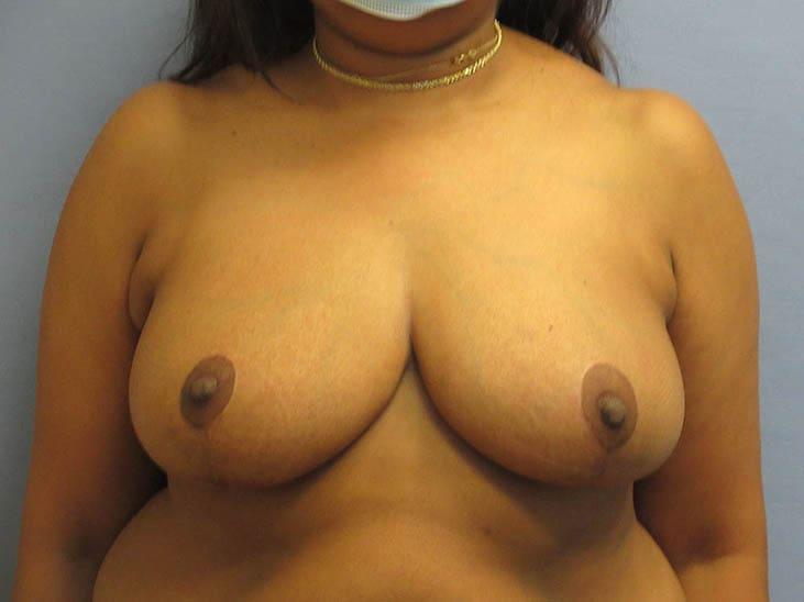 Parkcrest Plastic Surgery breast reduction after — St. Louis, MO