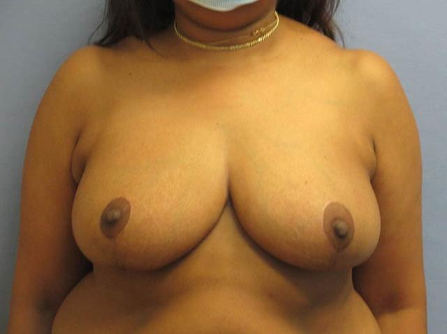 Breast Augmentation after at Parkcrest Plastic Surgery in St. Louis, MO