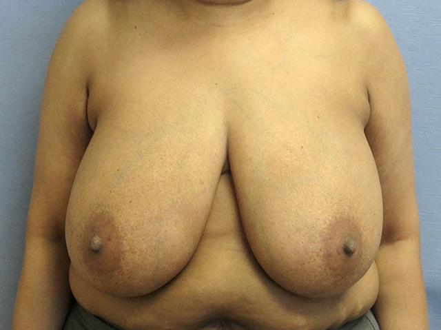 Breast Augmentation before at Parkcrest Plastic Surgery in St. Louis, MO