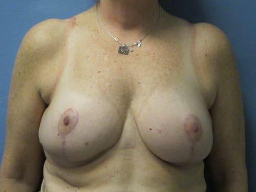 Breast Reduction after at Parkcrest Plastic Surgery in St. Louis, MO