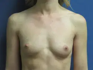 Breast Augmentation before at Parkcrest Plastic Surgery in St. Louis, MO