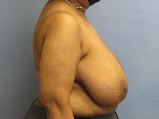 Breast Augmentation before at Parkcrest Plastic Surgery in St. Louis, MO