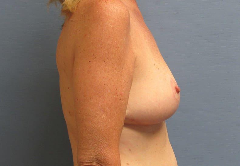 Parkcrest Plastic Surgery breast reduction after — St. Louis, MO