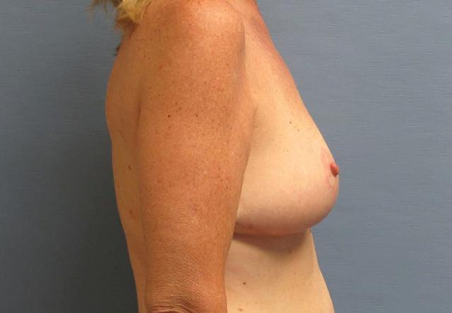 Breast Augmentation after at Parkcrest Plastic Surgery in St. Louis, MO