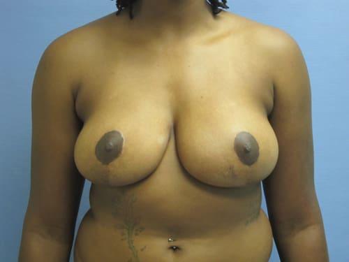 Breast Augmentation after at Parkcrest Plastic Surgery in St. Louis, MO