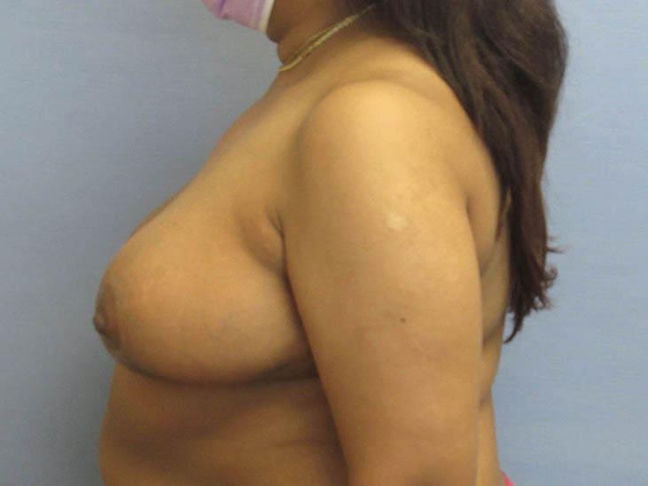 Parkcrest Plastic Surgery breast reduction after — St. Louis, MO