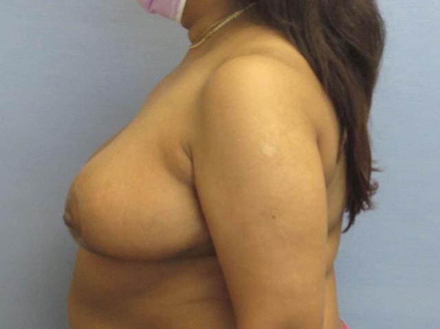 Breast Augmentation after at Parkcrest Plastic Surgery in St. Louis, MO